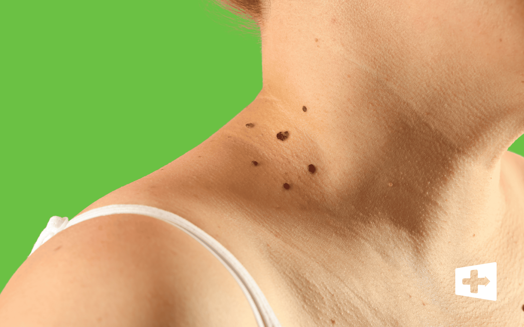 Melanoma Awareness Month: This Is Your Moment to Act