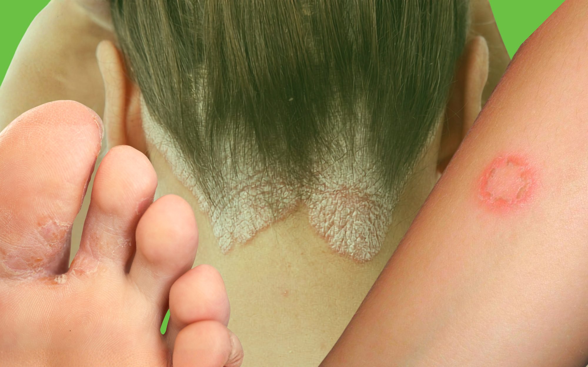Is That Summer Rash Really Just Sweat?